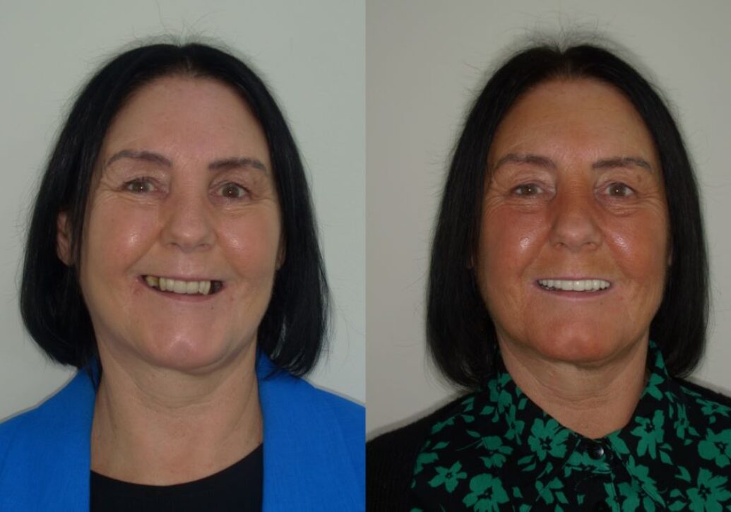 blog - Fusion Dental