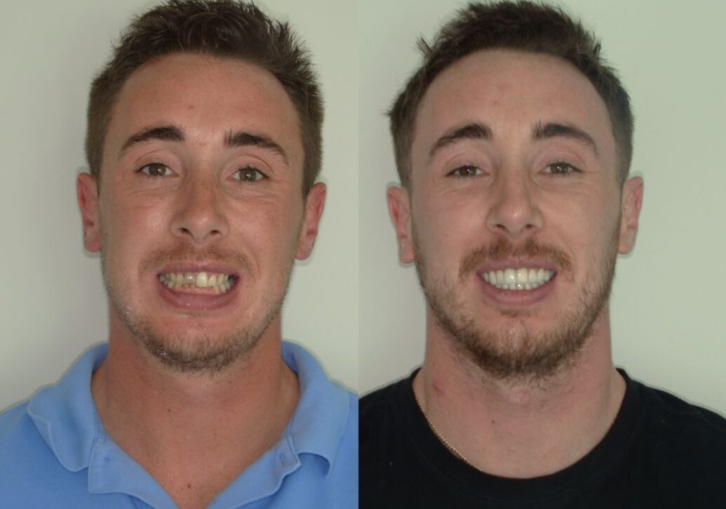 blog - Fusion Dental