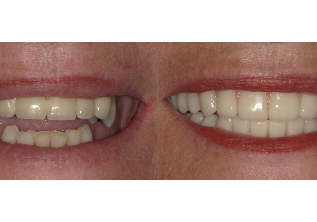 blog - Fusion Dental