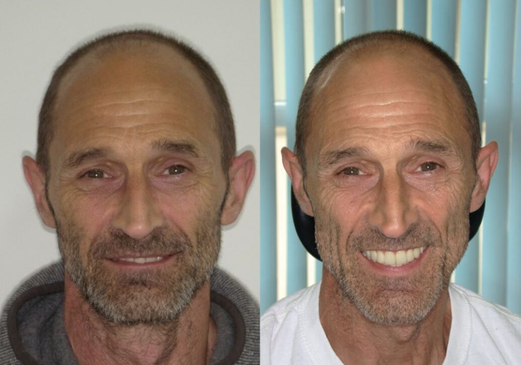 blog - Fusion Dental