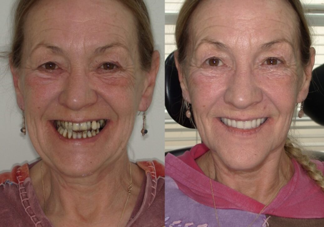 blog - Fusion Dental