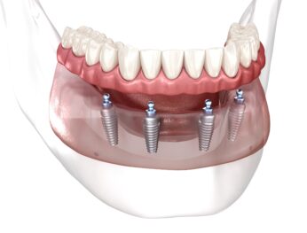 Fusiondental Dental Implant Image