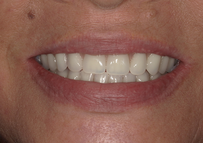 After -Fusion Dental