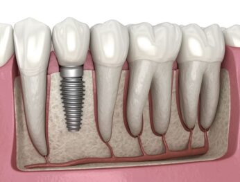 Fusiondental Dental Implant Image