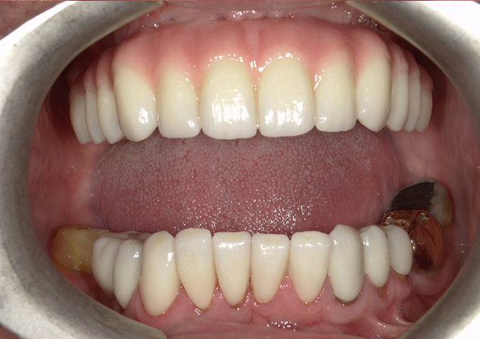 After -Fusion Dental