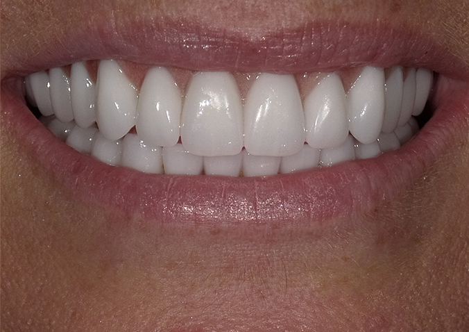 After -Fusion Dental