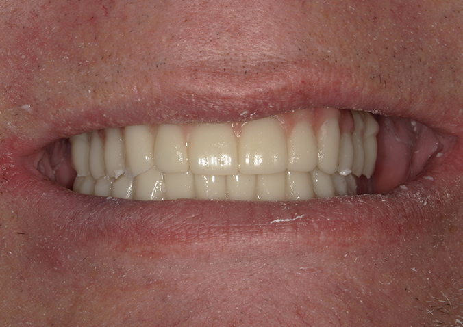 After -Fusion Dental