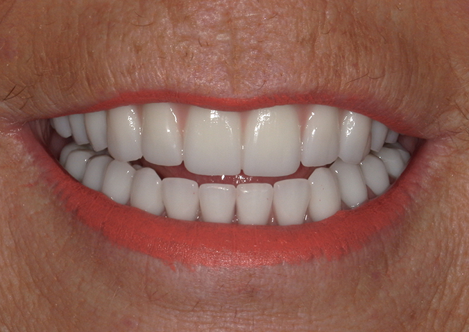 After -Fusion Dental