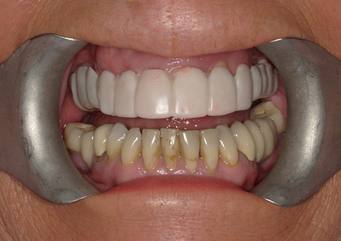 Before - Fusion Dental