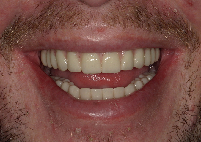 After -Fusion Dental