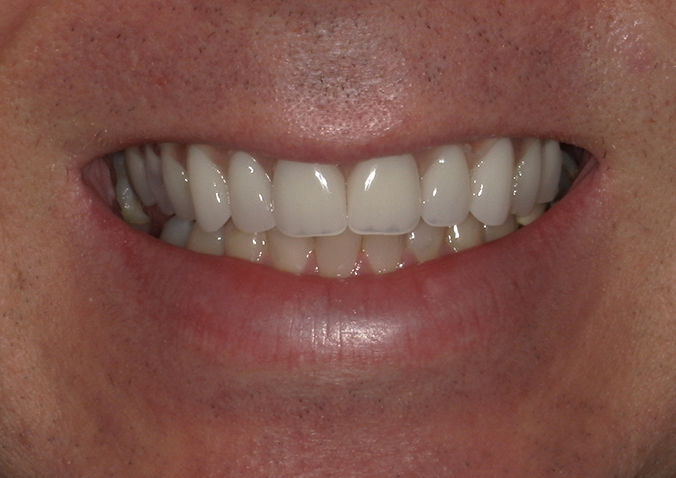 After -Fusion Dental