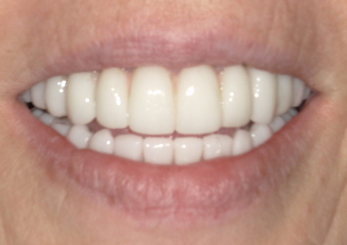 After -Fusion Dental