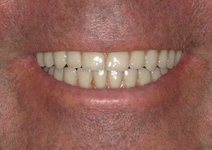 After -Fusion Dental