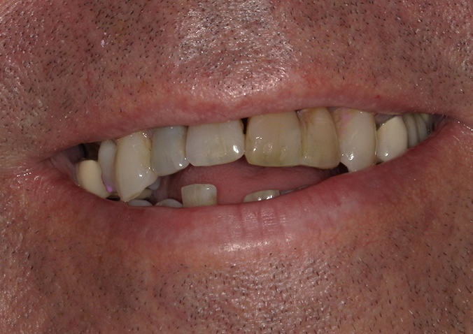 Before - Fusion Dental