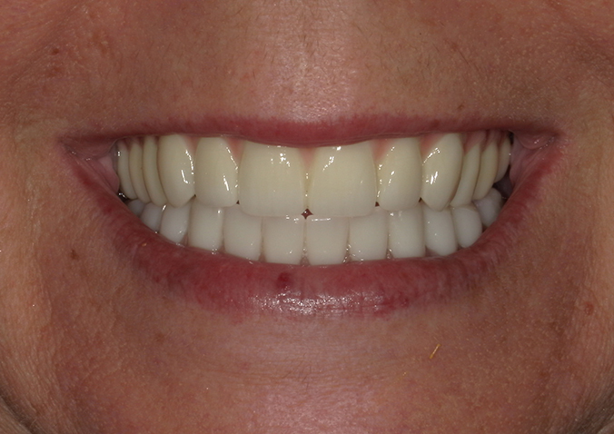 After -Fusion Dental