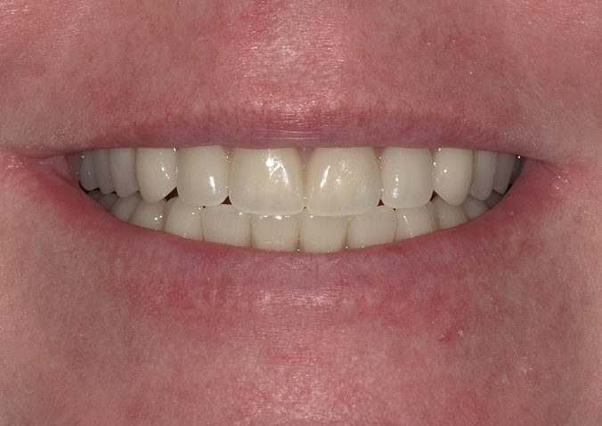 After -Fusion Dental