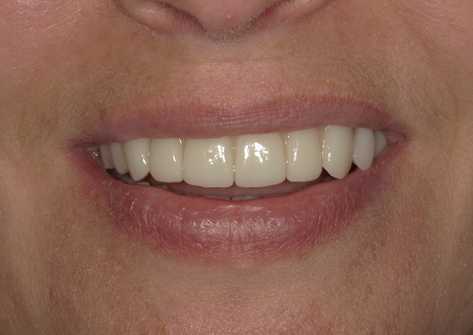 After -Fusion Dental