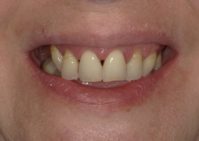 Before - Fusion Dental