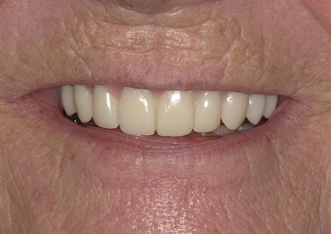 After -Fusion Dental