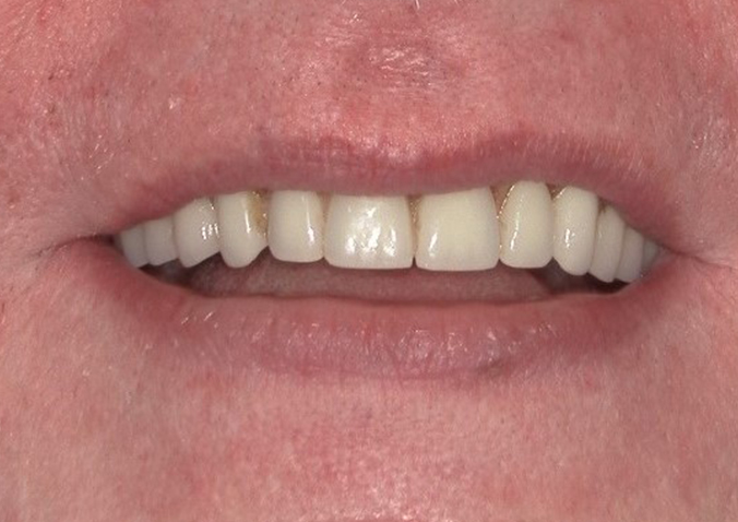 After -Fusion Dental