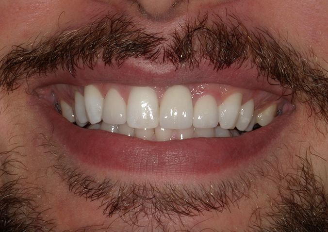 After -Fusion Dental