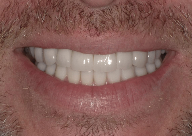 After -Fusion Dental