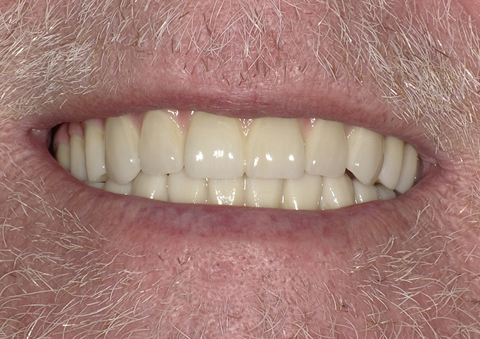 After -Fusion Dental