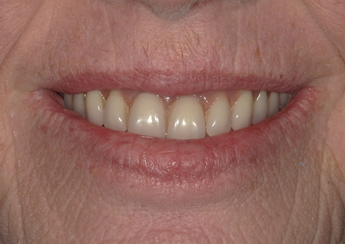 After -Fusion Dental