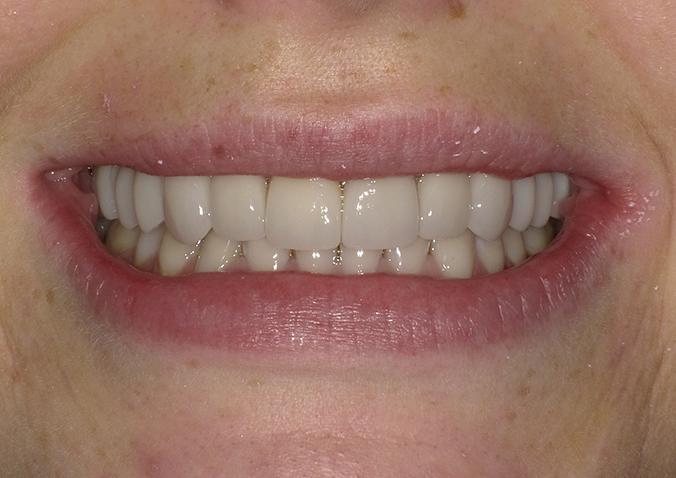 After -Fusion Dental