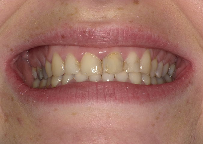 Before - Fusion Dental
