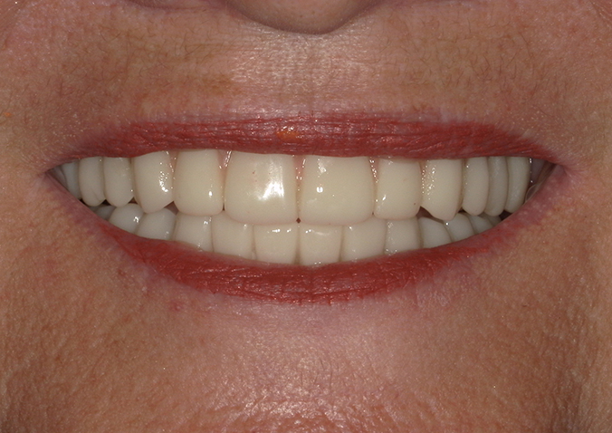 After -Fusion Dental